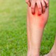 ¿Por qué me pican los mosquitos en las piernas?